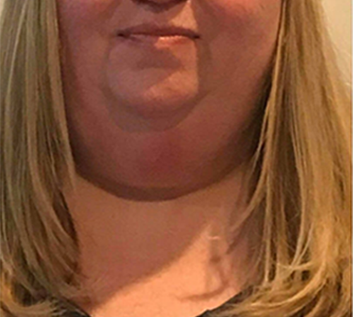 CryoDoublechin-Before